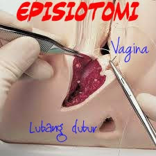 luka jahitan bersalin episiotomi