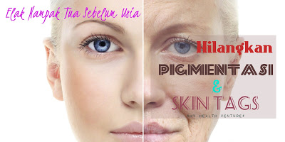 skin tags