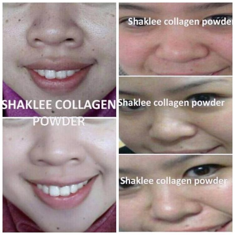 cara menghilangkan sunburn
