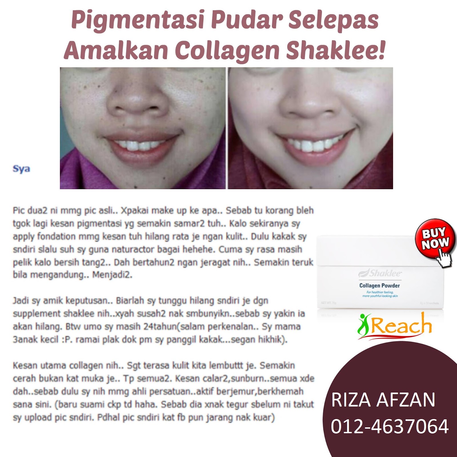 cara-menghilangkan-sunburn