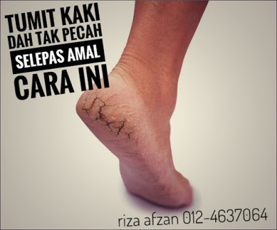 tumit kaki dah tak pecah