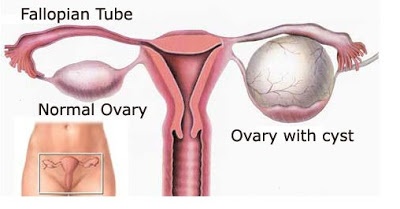 ikhtiar kecutkan cyst