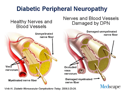 kebas kaki tangan diabetic neuropathy
