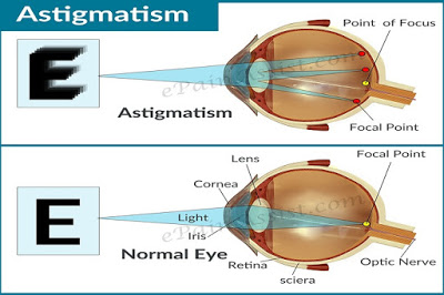 astigmatisme