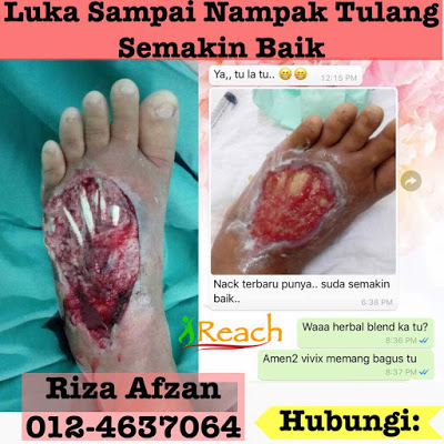 Luka kencing manis cepat sembuh