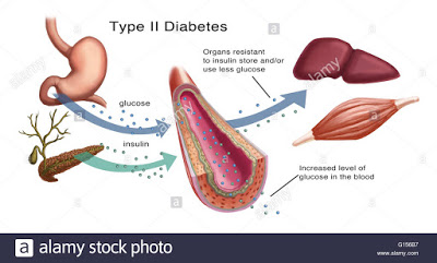 kerintangan insulin insulin resistance