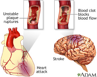 cegah stroke