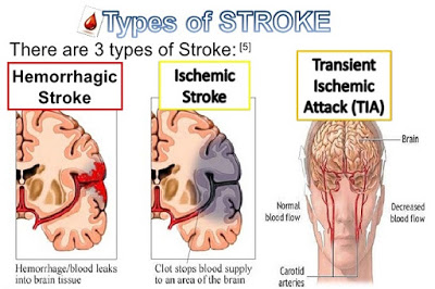 jenis-jenis stroke