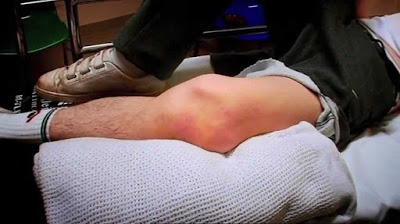 patellar dislocation kepala lutut longgar