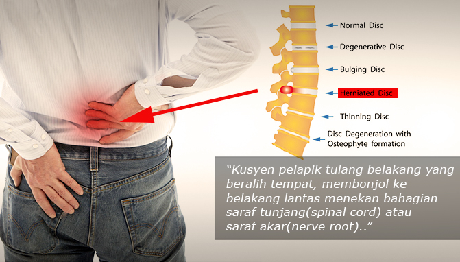 slip disc tips pakar