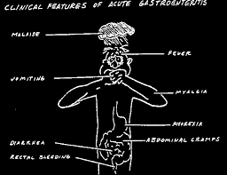 acute-gastroenteritis